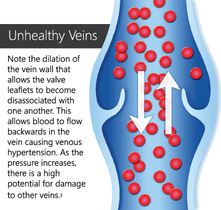 disease-vein