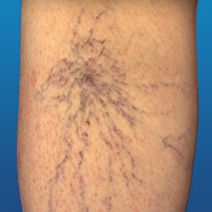 getting rid of spider veins on legs