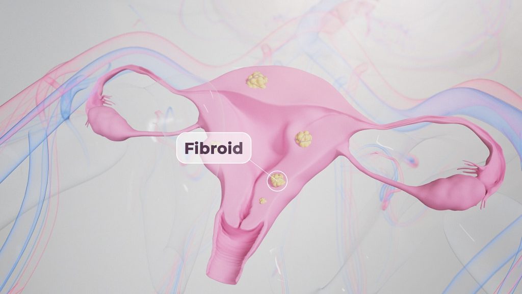 Fibroids growing on uterus